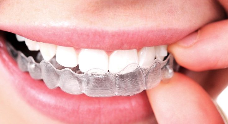 Tres problemas orales que puedes prevenir con Invisalign